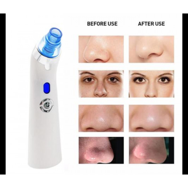 Електричний пристрій для видалення чорних цяток DYM-001 з 5 рівнями всмоктування та 4 насадками